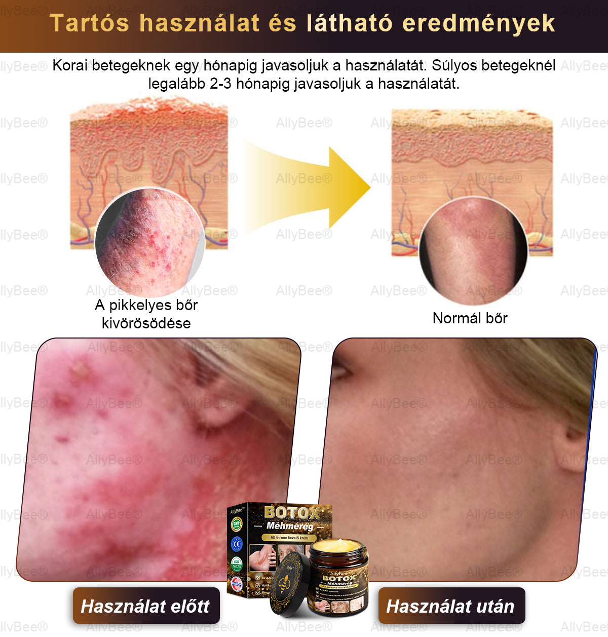 đšâđŹ AllyBeeÂź Botox BĆrĂĄpolĂł KrĂ©m RĂĄnctalanĂtĂĄs, HidratĂĄlĂĄs, BĆrregenerĂĄlĂĄs, Egyenletes BĆrtĂłnus, PattanĂĄs- Ă©s SötĂ©tfolt KezelĂ©s, Szemölcs- Ă©s Anyajegyek EltĂĄvolĂtĂĄsa