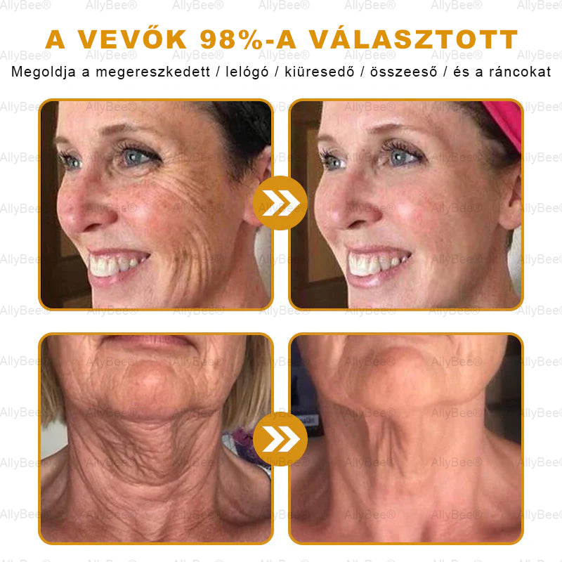 đšâđŹ AllyBeeÂź Botox BĆrĂĄpolĂł KrĂ©m RĂĄnctalanĂtĂĄs, HidratĂĄlĂĄs, BĆrregenerĂĄlĂĄs, Egyenletes BĆrtĂłnus, PattanĂĄs- Ă©s SötĂ©tfolt KezelĂ©s, Szemölcs- Ă©s Anyajegyek EltĂĄvolĂtĂĄsa