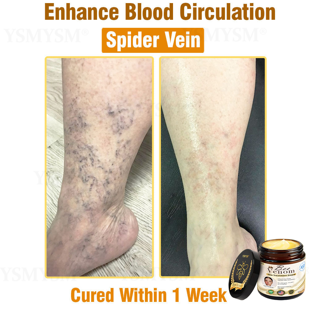 YSMYSM® Powerful All-Body Skin Treatment Cream (Recommended by multiple dermatologists)