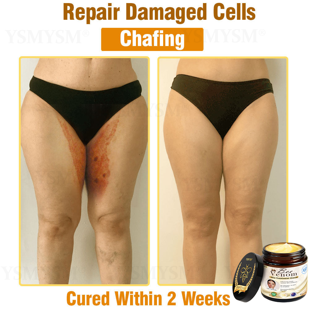 YSMYSM® Powerful All-Body Skin Treatment Cream (Recommended by multiple dermatologists)