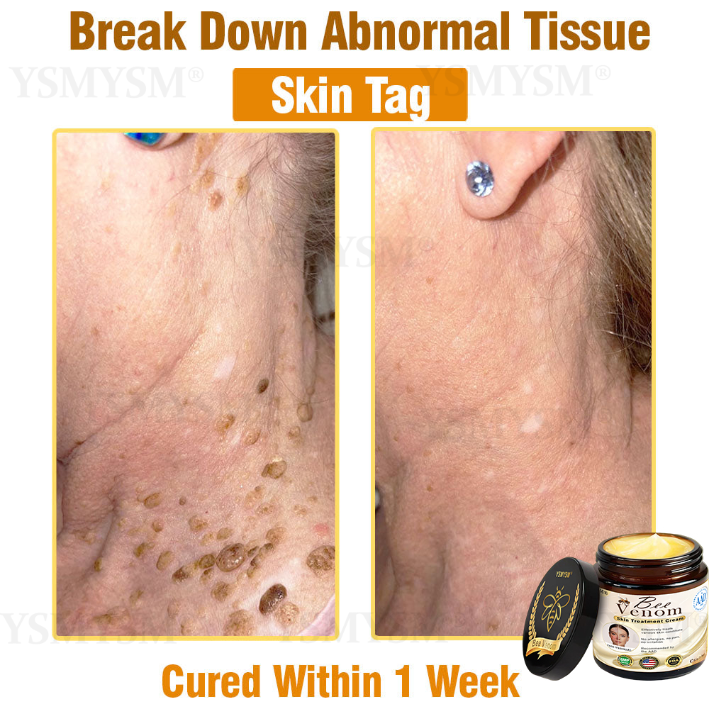 YSMYSM® Powerful All-Body Skin Treatment Cream (Recommended by multiple dermatologists)