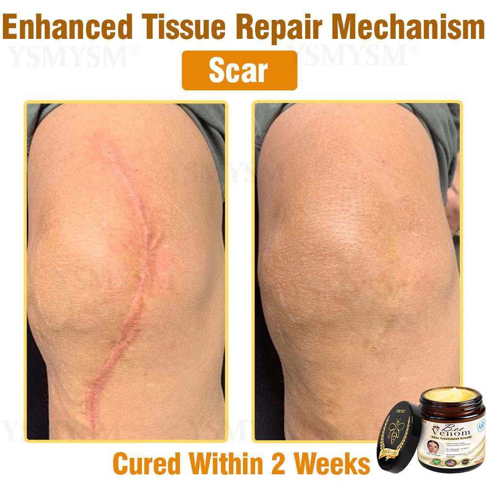 YSMYSM® Powerful All-Body Skin Treatment Cream (Recommended by multiple dermatologists)