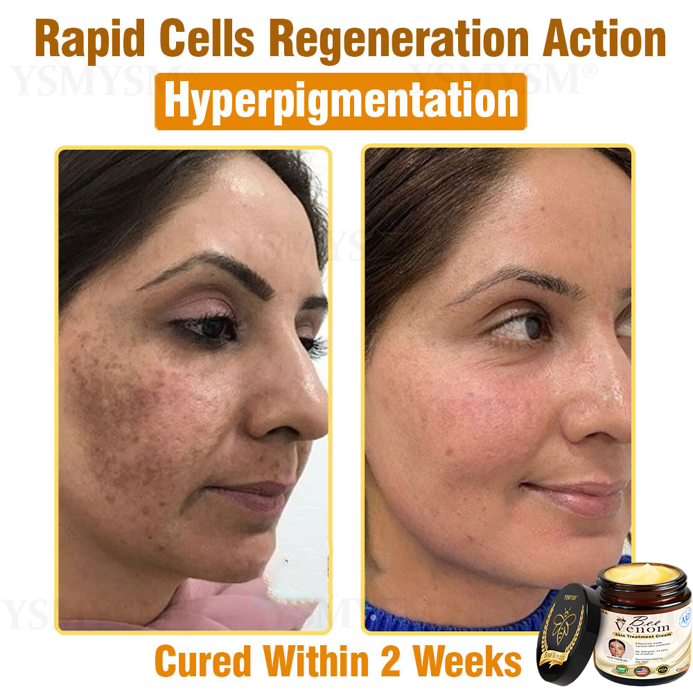 YSMYSM® Powerful All-Body Skin Treatment Cream (Recommended by multiple dermatologists)
