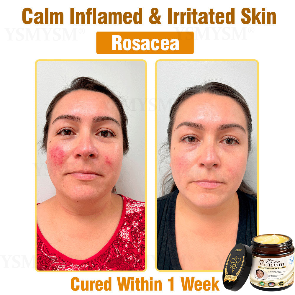Mayo Clinic Recommended | Official Store | YSMYSM® Full-Body Repair Cream: Anti-Aging, Hydration, Skin Repair, Even Tone, Acne & Dark Spot Treatment, Wart & Mole Removal, Psoriasis Relief