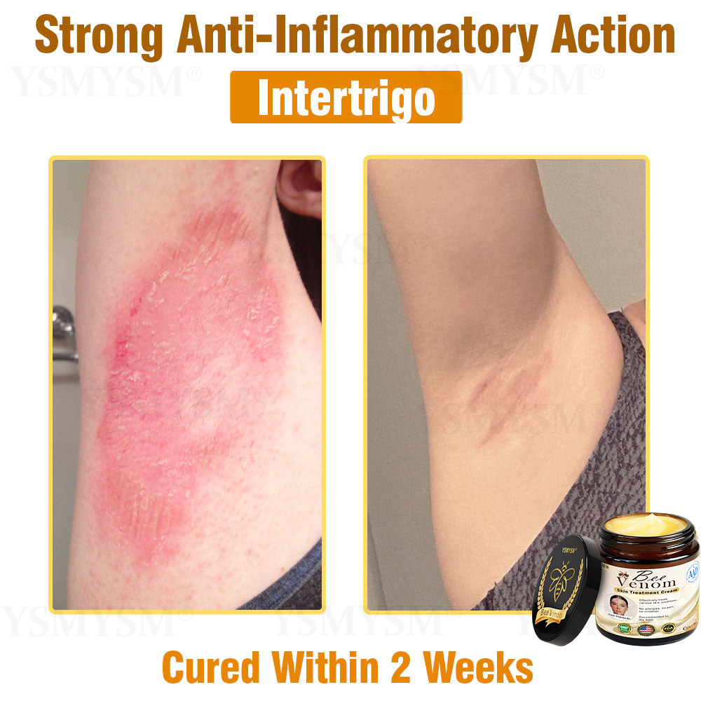 YSMYSM® Powerful All-Body Skin Treatment Cream (Recommended by multiple dermatologists)