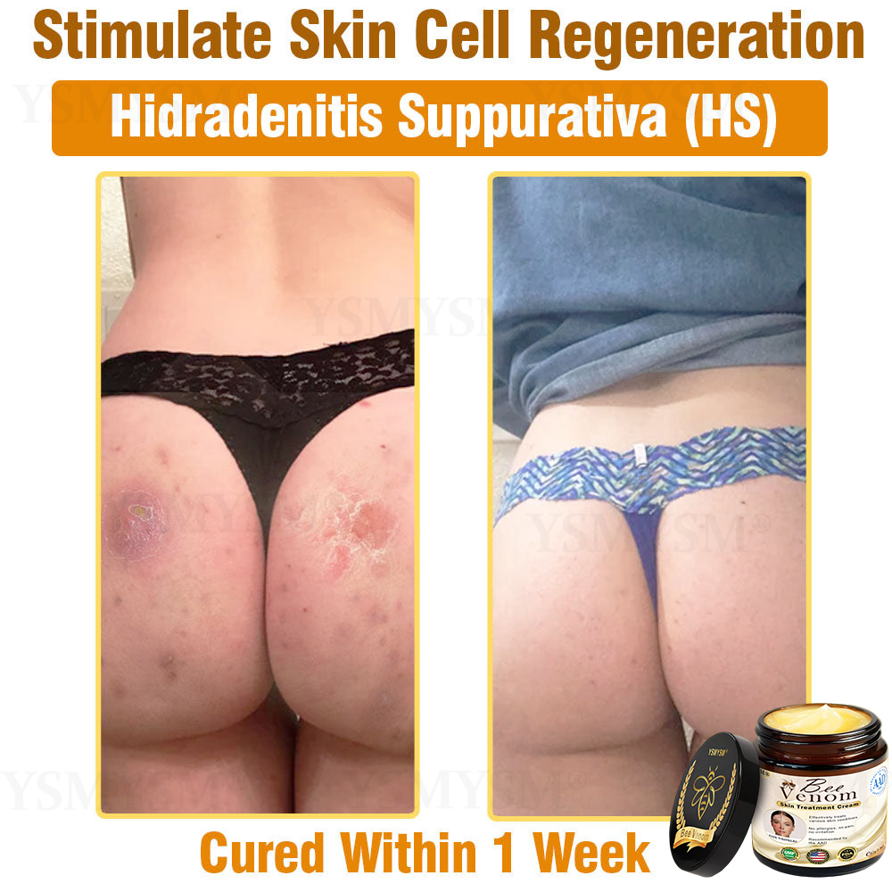 YSMYSM® Powerful All-Body Skin Treatment Cream (Recommended by multiple dermatologists)